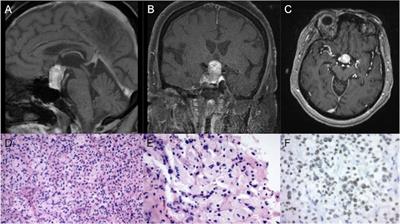 Comprehensive Genomic Characterization of A Case of Granular Cell Tumor of the Posterior Pituitary Gland: A Case Report